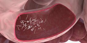 Hármasok használata a paraziták eltávolítására