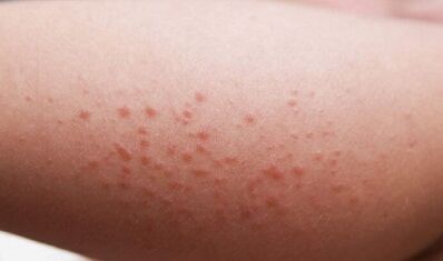 a paraziták jelenlétének külső megnyilvánulásai a szervezetben