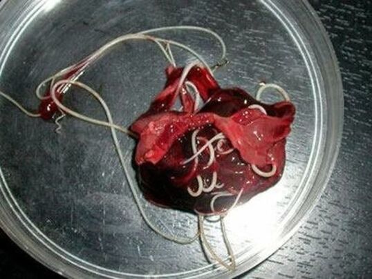 férgek az emberi testből